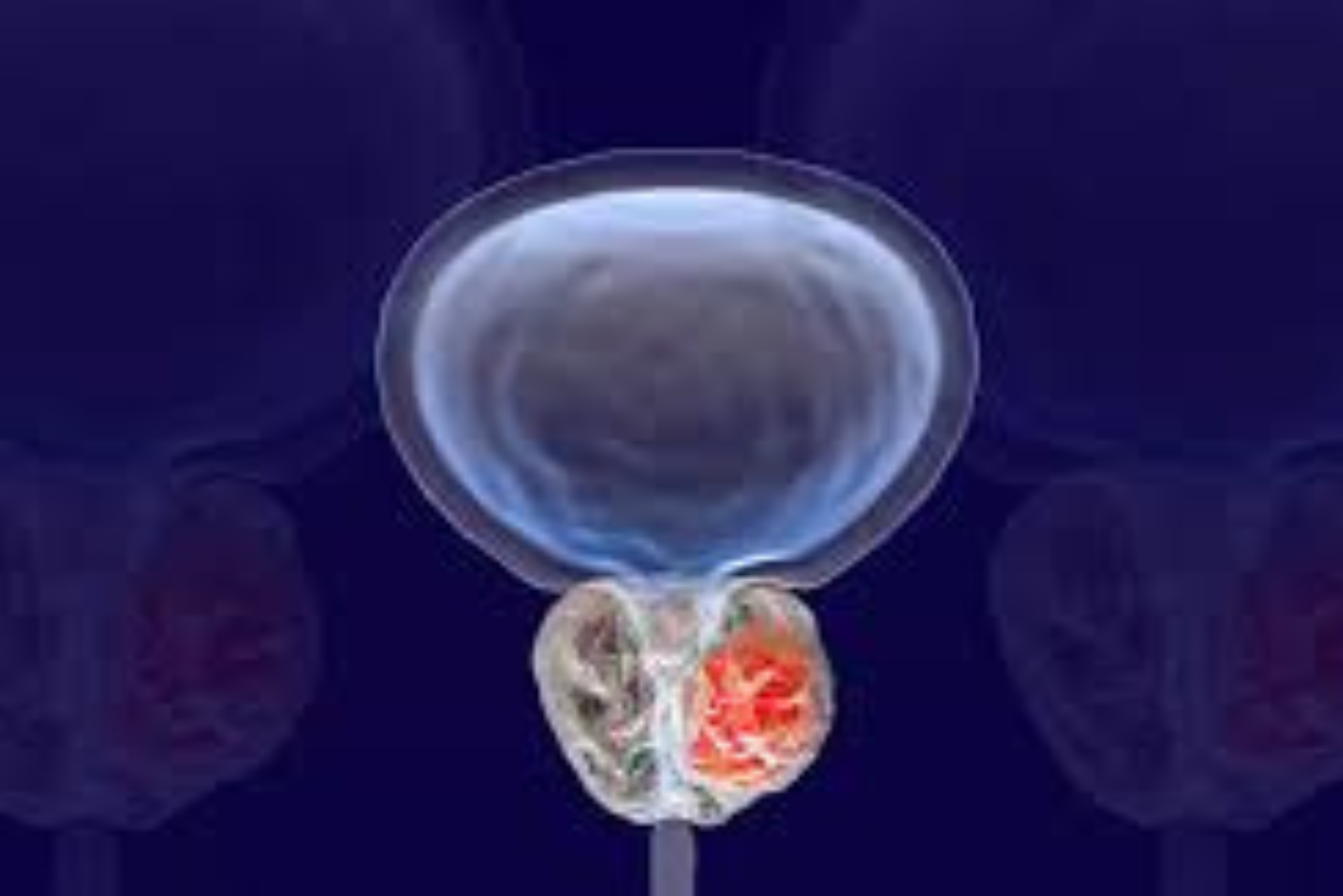 Prostatectomia Radical Robótica: Avanços no Tratamento do Câncer de Próstata