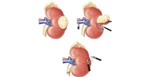 Pagina Principal1 8 Tratamento de Câncer de Rim