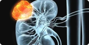 Pagina Principal1 4 Câncer de rim em imagem médica