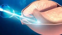 Próstata aumentada: Sintomas e melhores tratamentos 7 cirurgia a laser da próstata