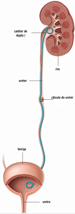 Tratamento de Pedra no Rim em Sorriso: Quando Procurar um Urologista e Quando a Cirurgia a Laser é Indicada 5 cateter duplo J