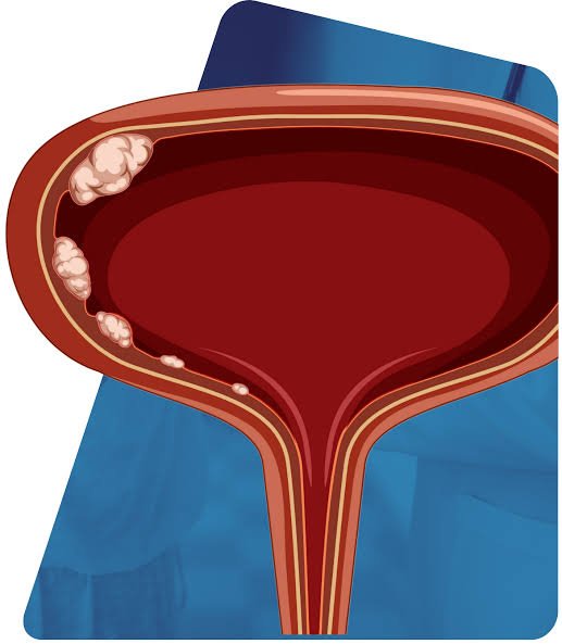 sintomas cancer de bexiga